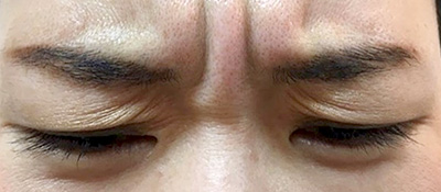 ボトックス 症例1 Before