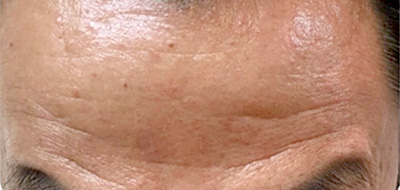 ボトックス 症例2 After