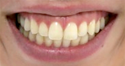 ボトックス 症例3 Before