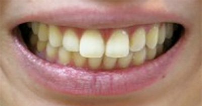 ボトックス 症例3 After