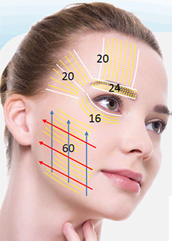浅層の照射「ハイフシャワー」