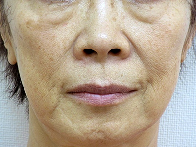 ヒアルロン酸｜赤坂スキンクリニック美容皮膚科（東京都港区