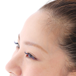 毛穴が広がりやすい部分 おでこ