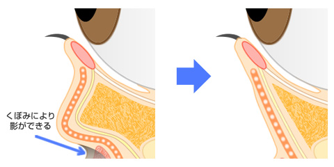 くまの原因 黒ぐま（目の下のたるみや、凹み）