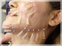 ショッピングスレッド（ショッピングリフト） 顔の左半分を治療中