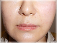 ショッピングスレッド（ショッピングリフト） 治療直後