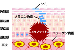 しみができるメカニズム