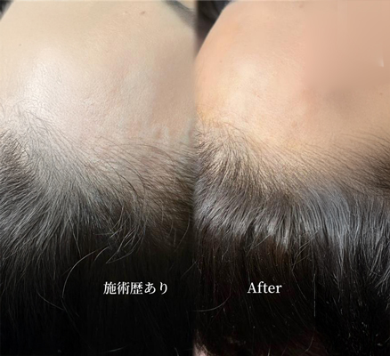 ヘアライン